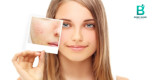 Acne and Acne Spots Removal